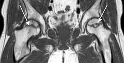 大腿骨頭壊死症のMRI T1強調像