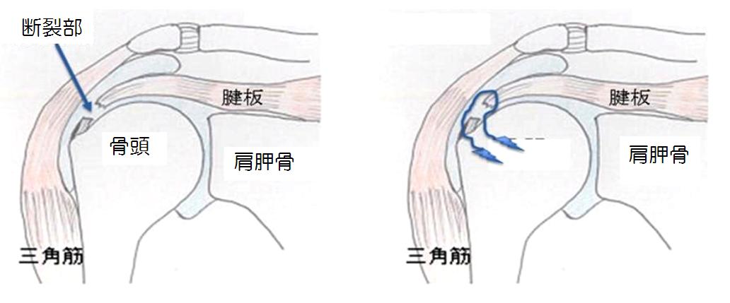 腱 板 断裂