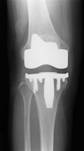 人工膝関節置換術術後